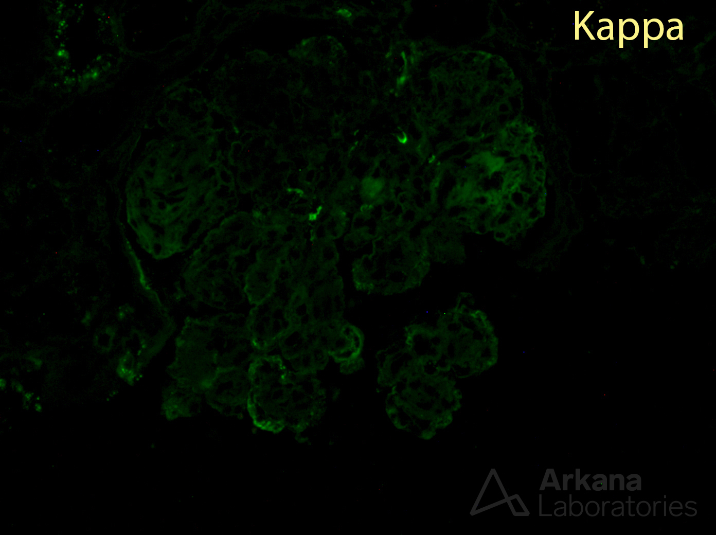 monoclonal gammopathy of renal significance