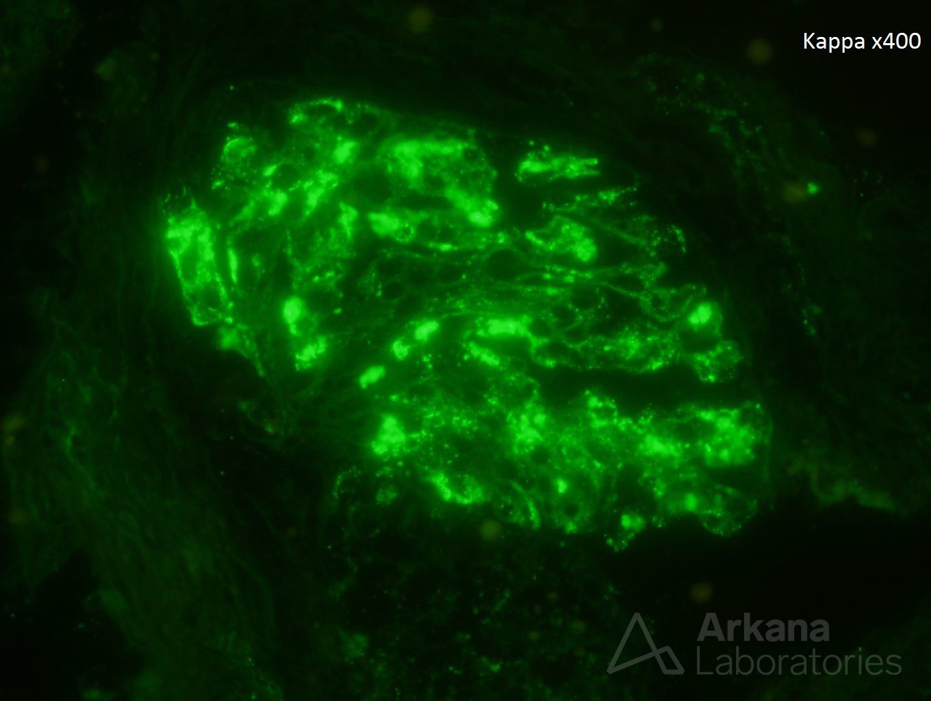 cryoglobulinemia