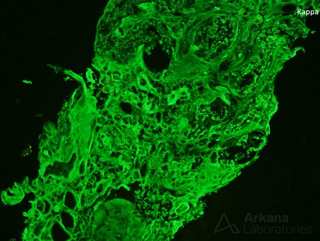 light chain deposition disease