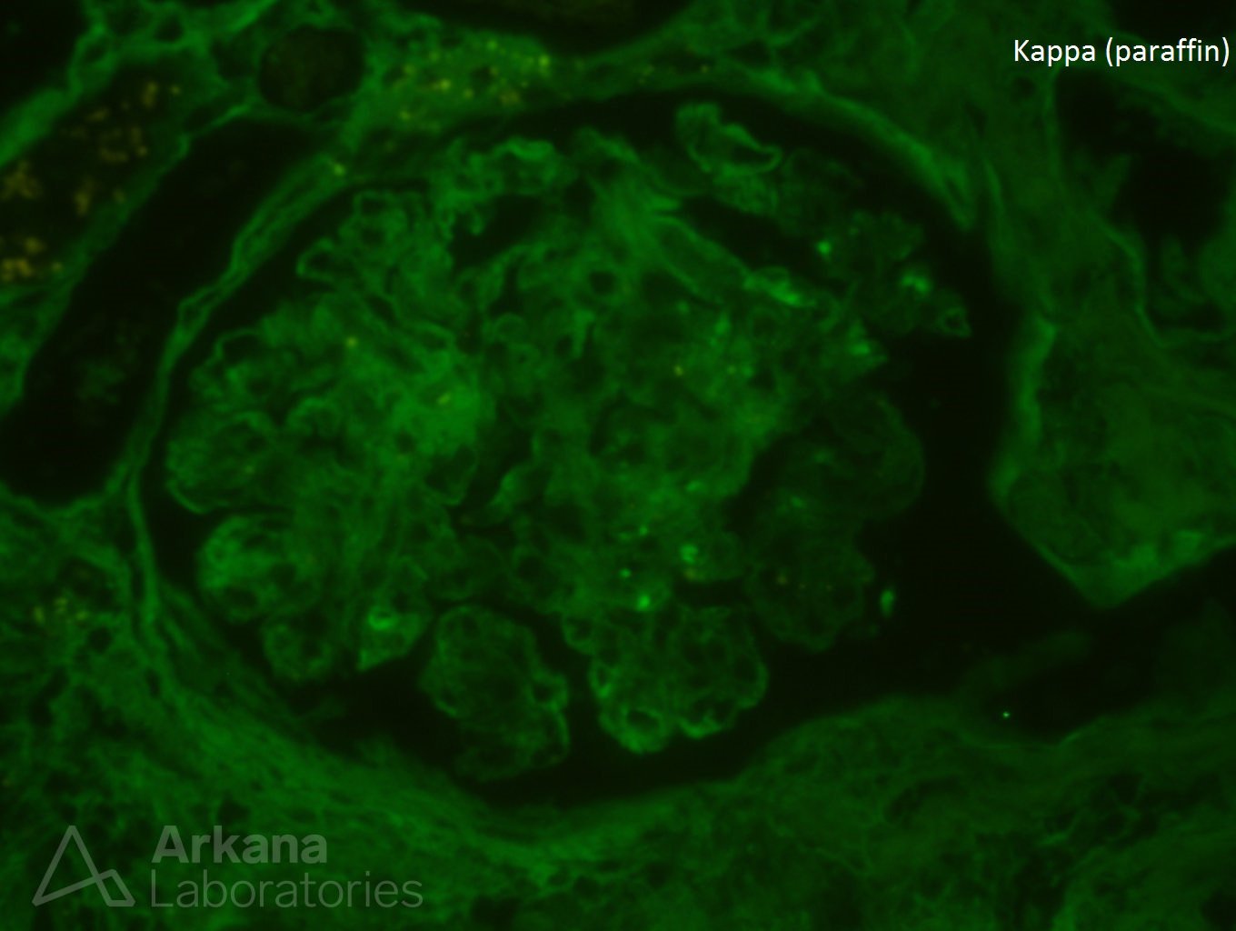 type I cryoglobulinemia