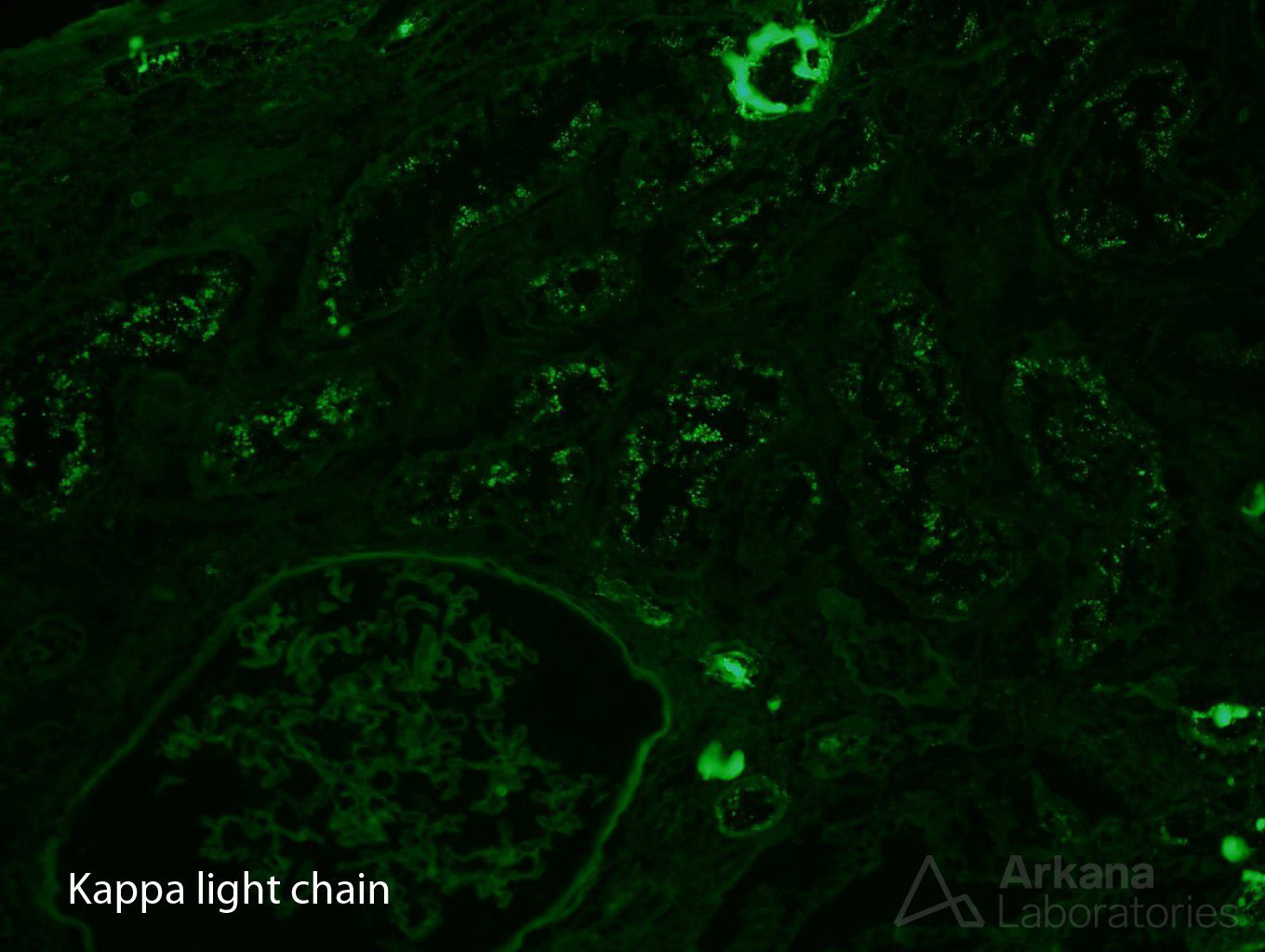 AL amyloidosis