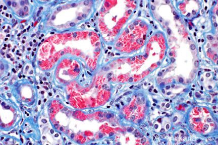 LCPT, Light Chain Proximal Tubulopathy Crystals