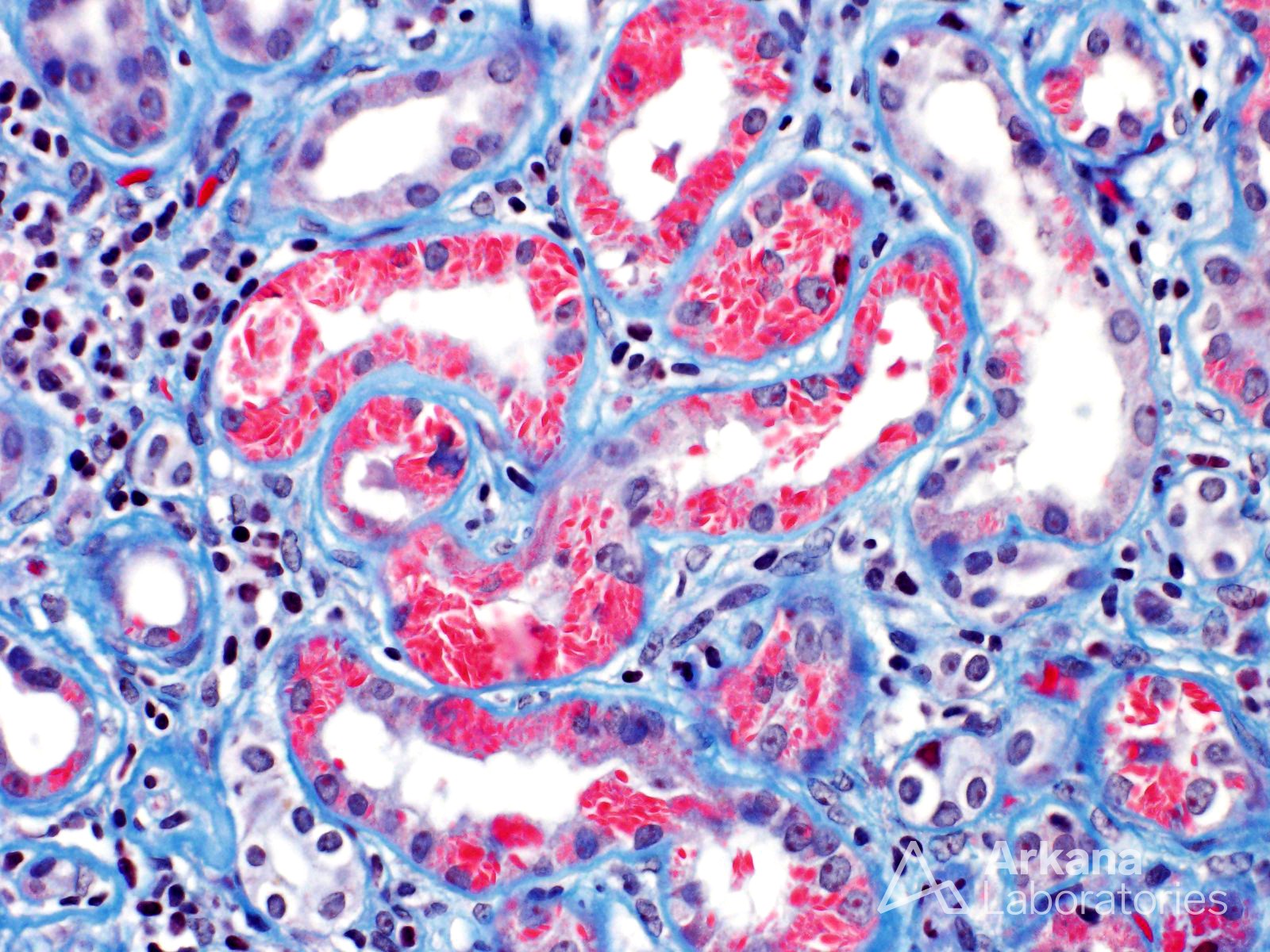 LCPT, Light Chain Proximal Tubulopathy Crystals