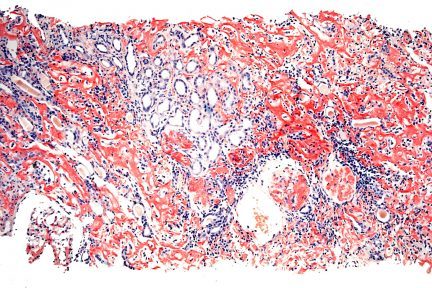 Amyloid Composed of Leukocyte Chemotactic Factor 2 (LECT2)