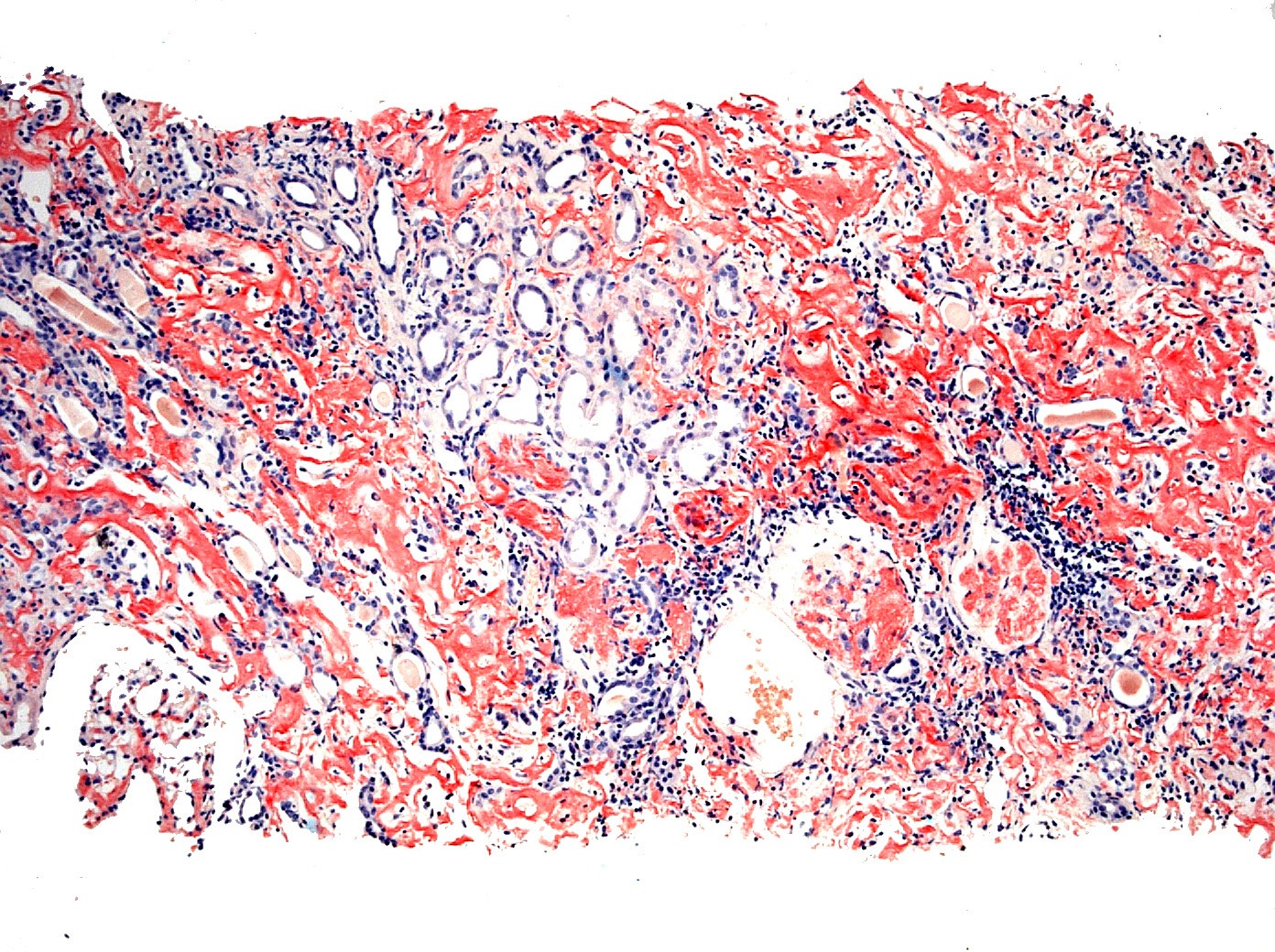 Amyloid Composed of Leukocyte Chemotactic Factor 2 (LECT2)