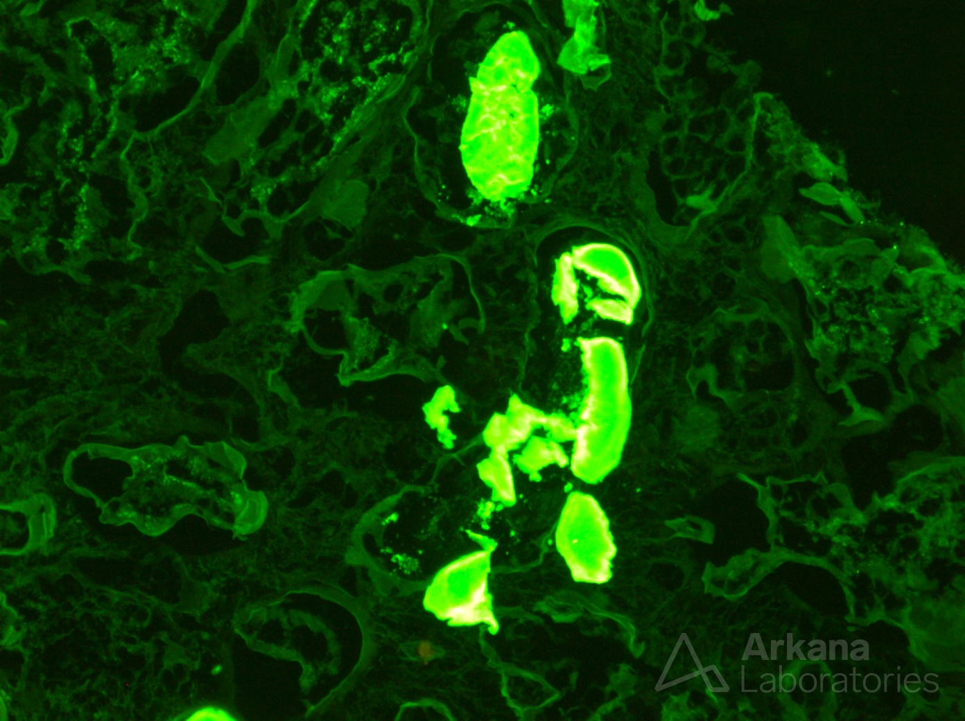 Amyloid Cast Nephropathy