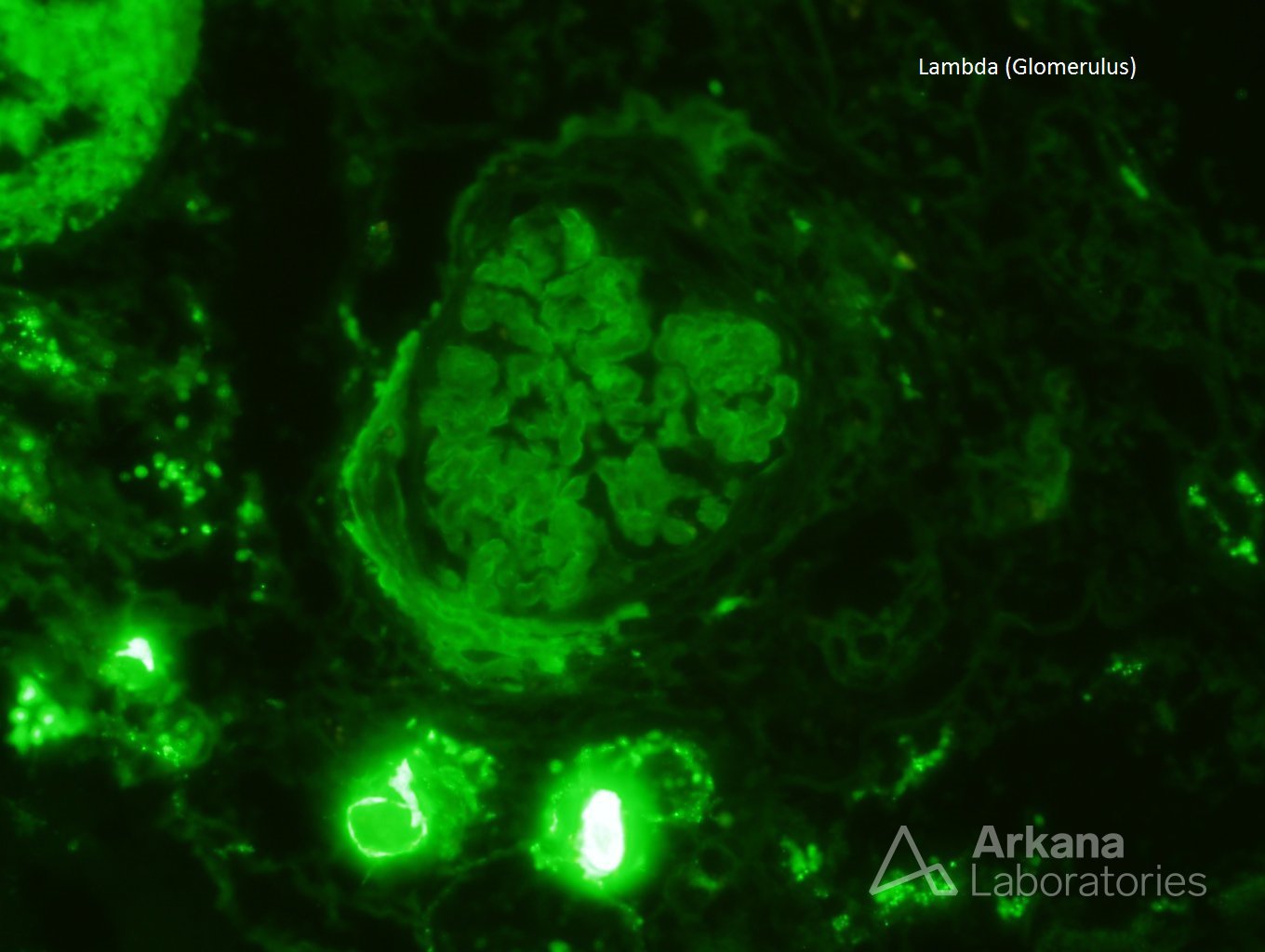 Lambda IF positive stain showing Amyloidosis