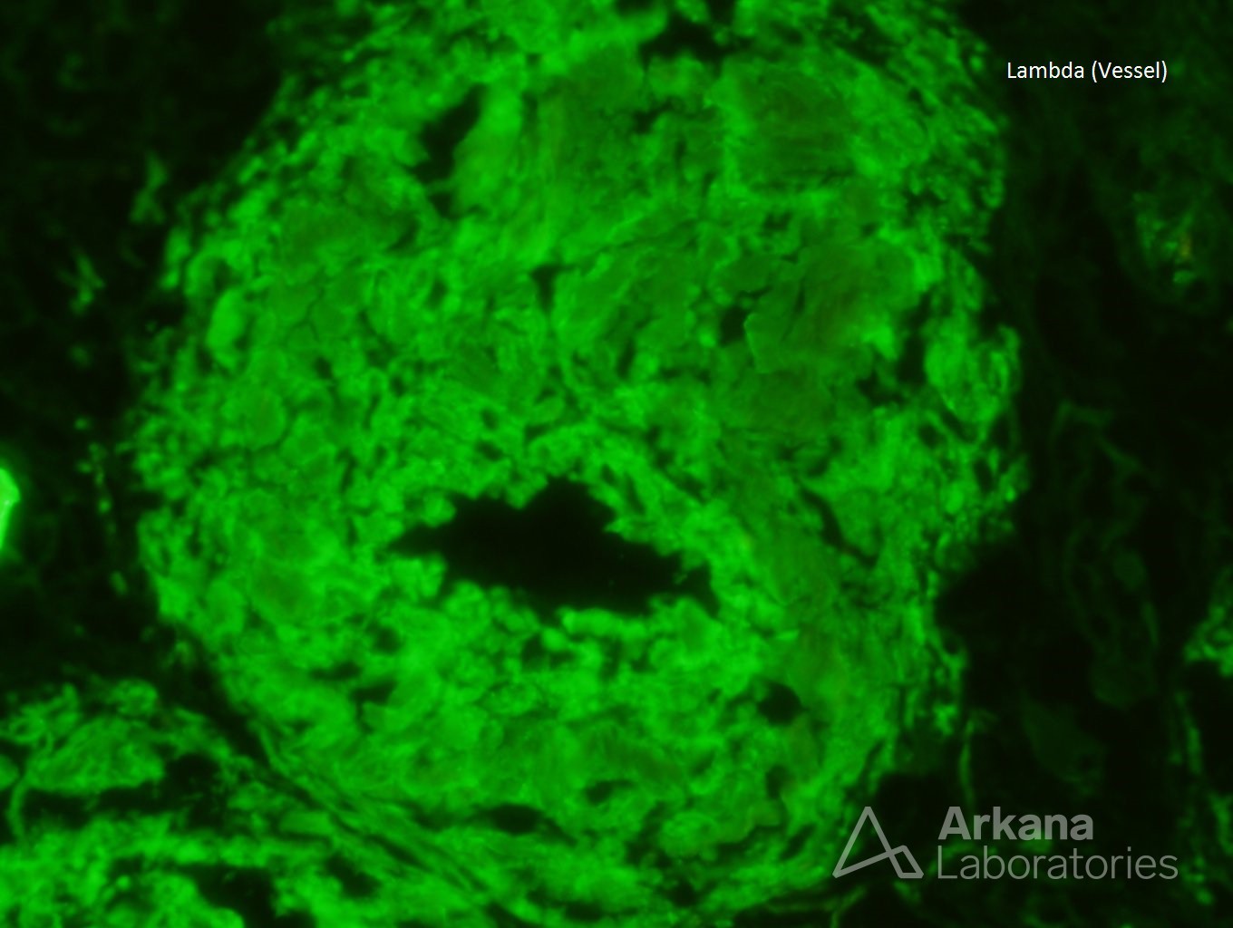 Positive Lambda IF stain showing Amyloidosis