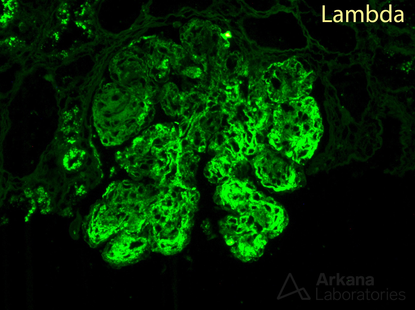 monoclonal gammopathy of renal significance