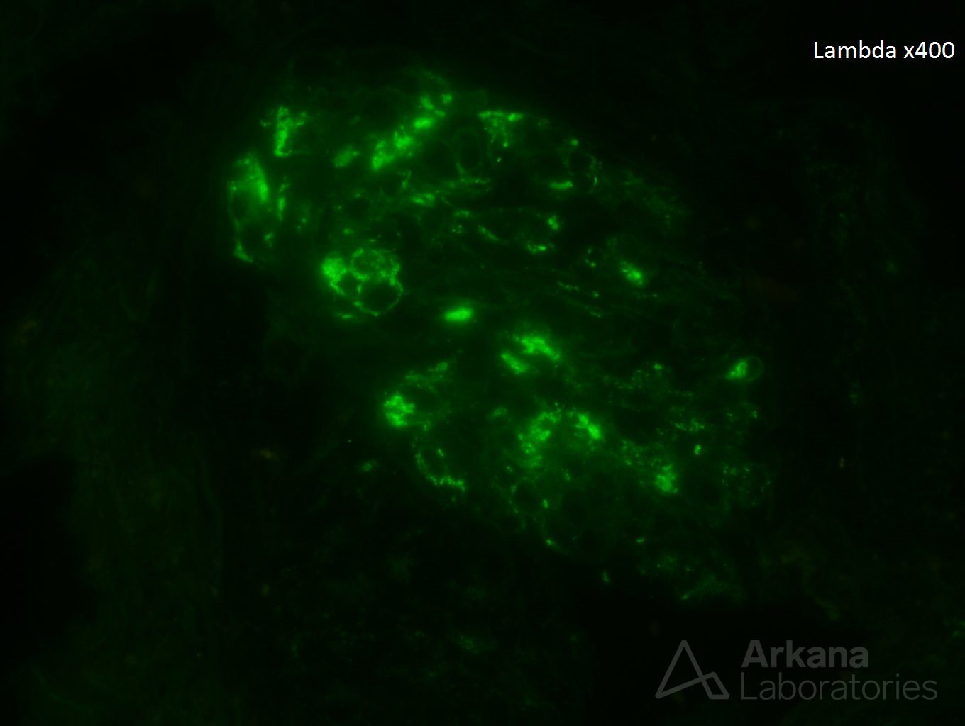 cryoglobulinemia