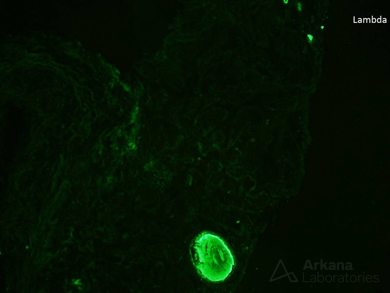 light chain deposition disease