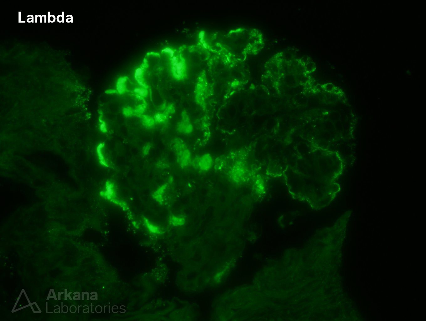 type I cryoglobulinemia