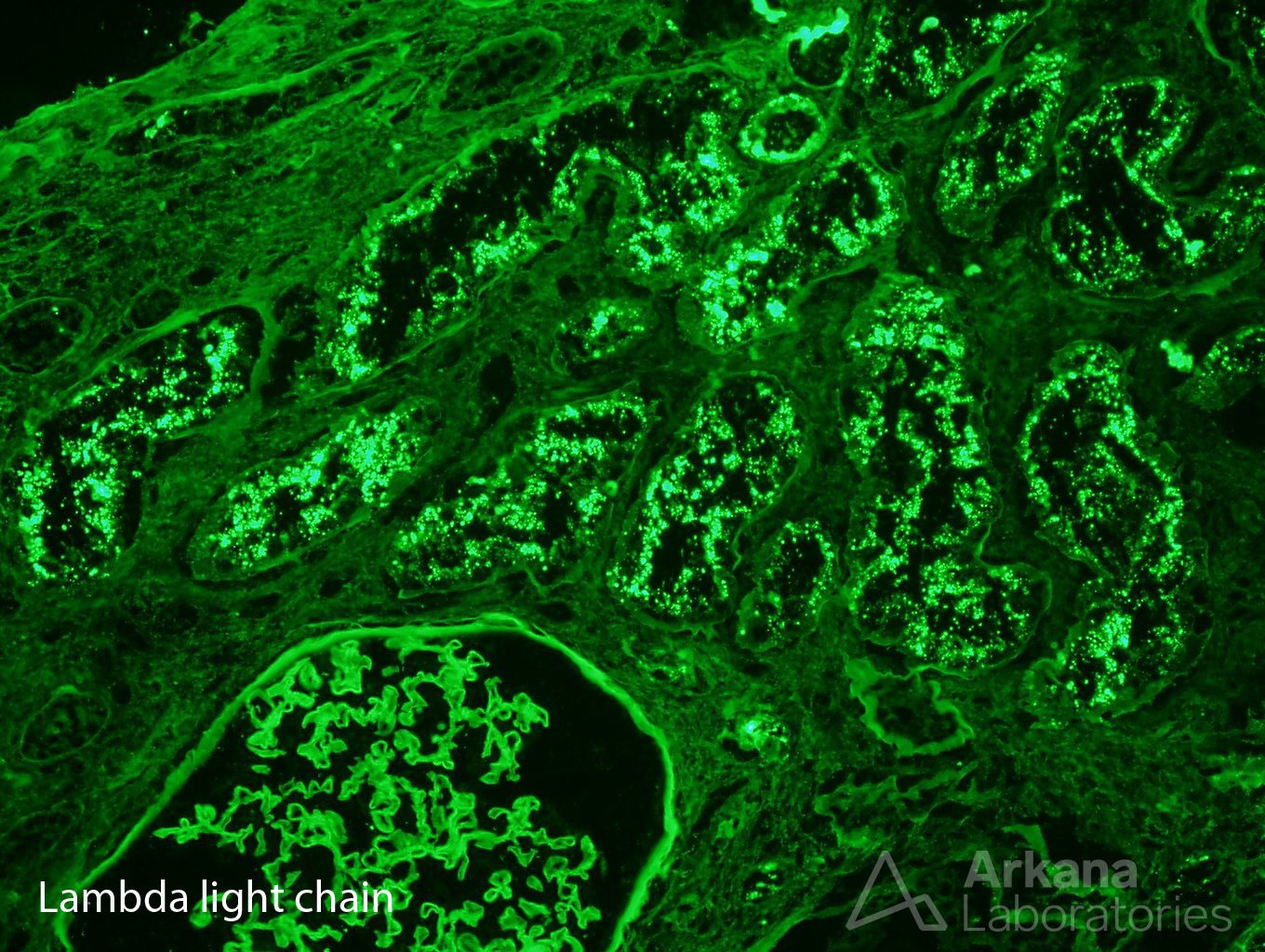 AL amyloidosis