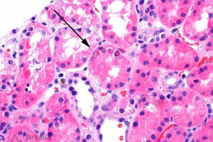 Lead Toxicity, Nephrotoxicity