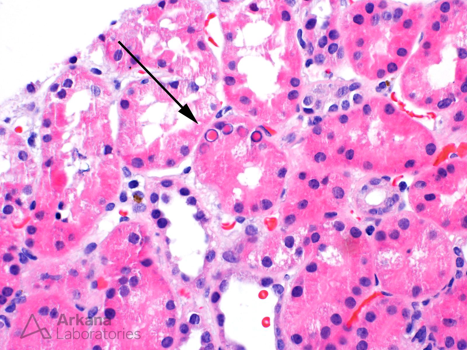 Lead Toxicity, Nephrotoxicity