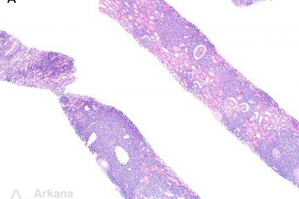 Large B-cell Lymphoma, arkana laboratories, pushing glass