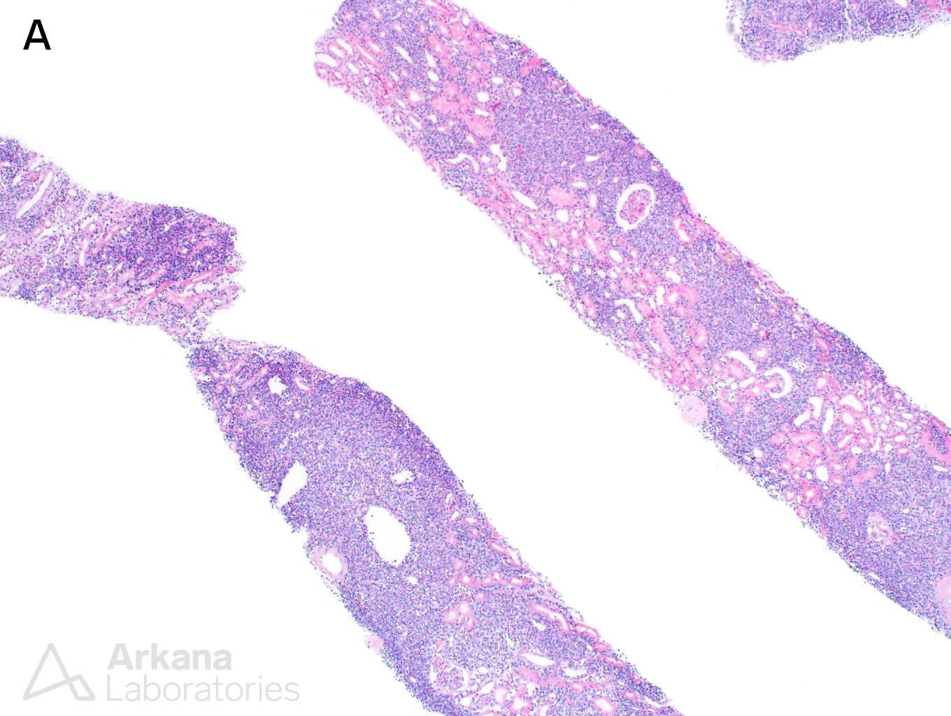 Large B-cell Lymphoma, arkana laboratories, pushing glass