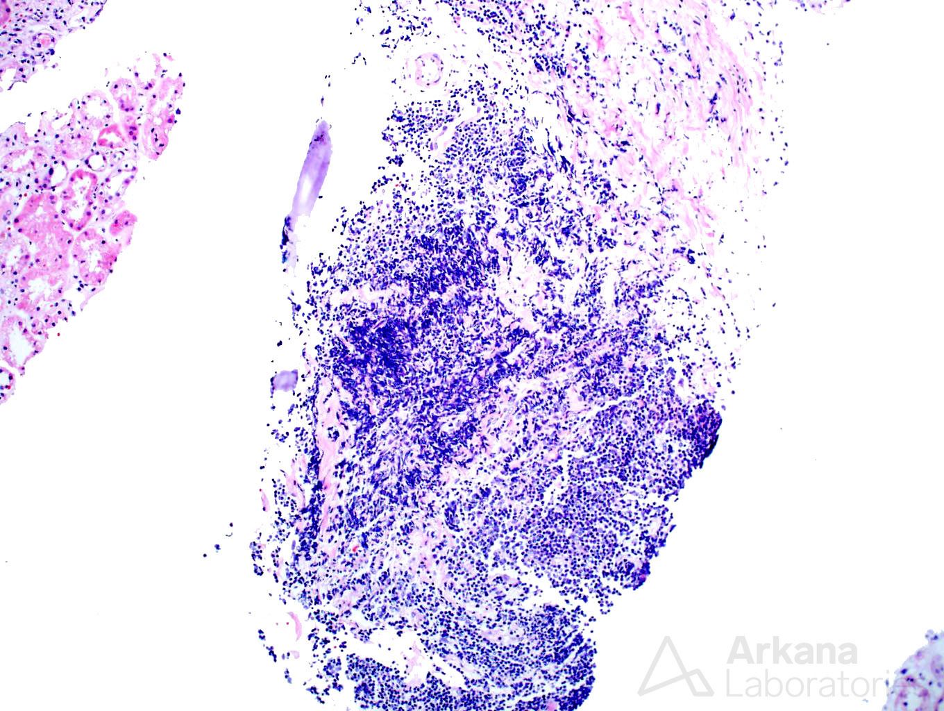 light chain deposition disease