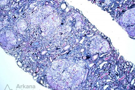 Granulomatous Interstitial Nephritis