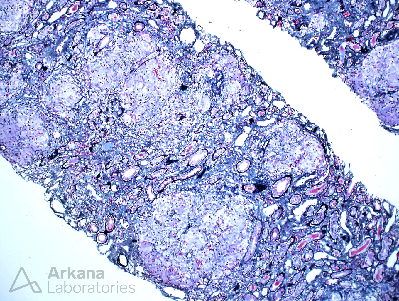 Granulomatous Interstitial Nephritis