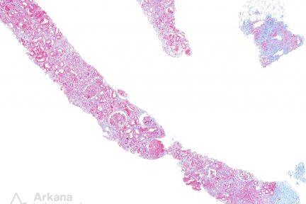 intravascular diffuse large B-cell lymphoma, arkana laboratories, pushing glass, renal pathology