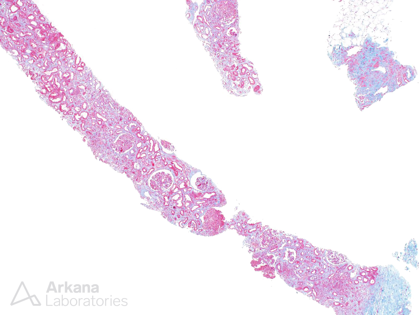 intravascular diffuse large B-cell lymphoma, arkana laboratories, pushing glass, renal pathology