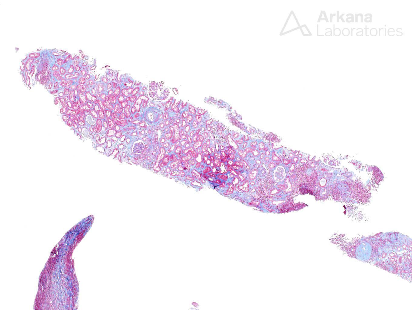 type I cryoglobulinemia