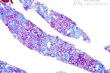 acute antibody-mediated rejection