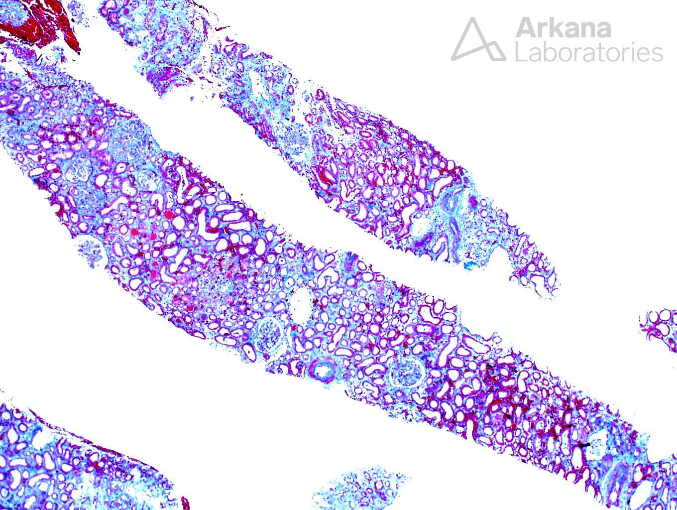 acute antibody-mediated rejection