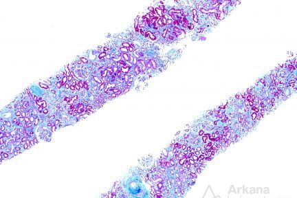 light chain deposition disease, pushing glass, arkana laboratories, kidney pathology