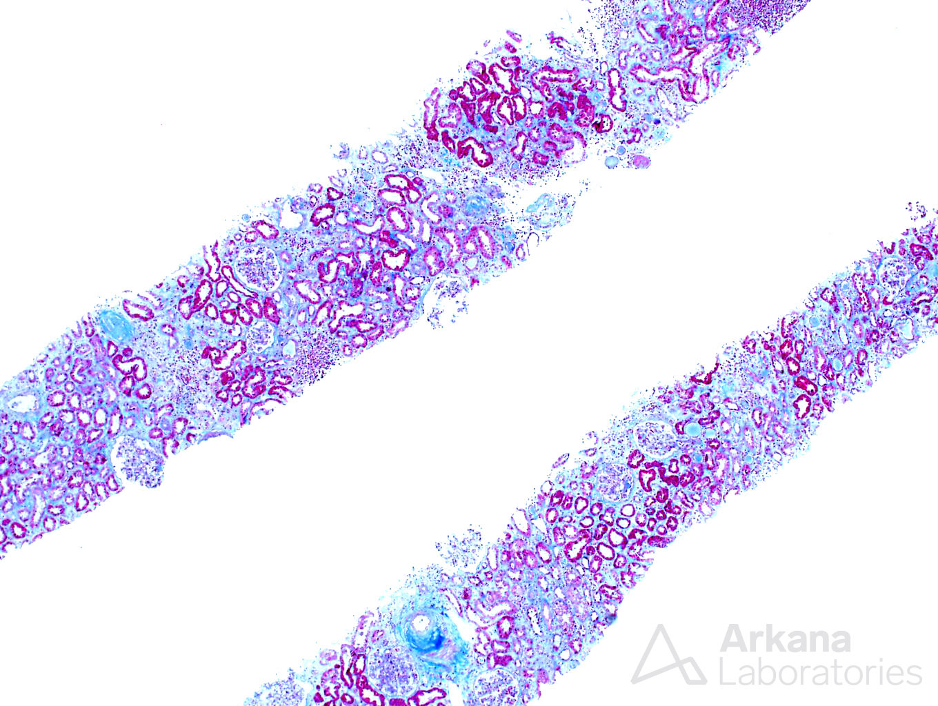 light chain deposition disease, pushing glass, arkana laboratories, kidney pathology