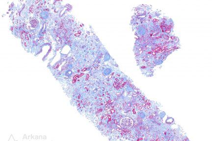 Amyloidosis, ALect2-Type, arkana laboratories, pushing glass