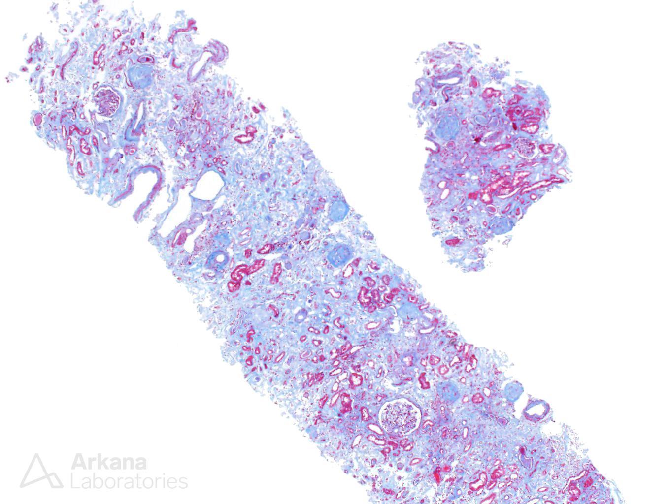 Amyloidosis, ALect2-Type, arkana laboratories, pushing glass