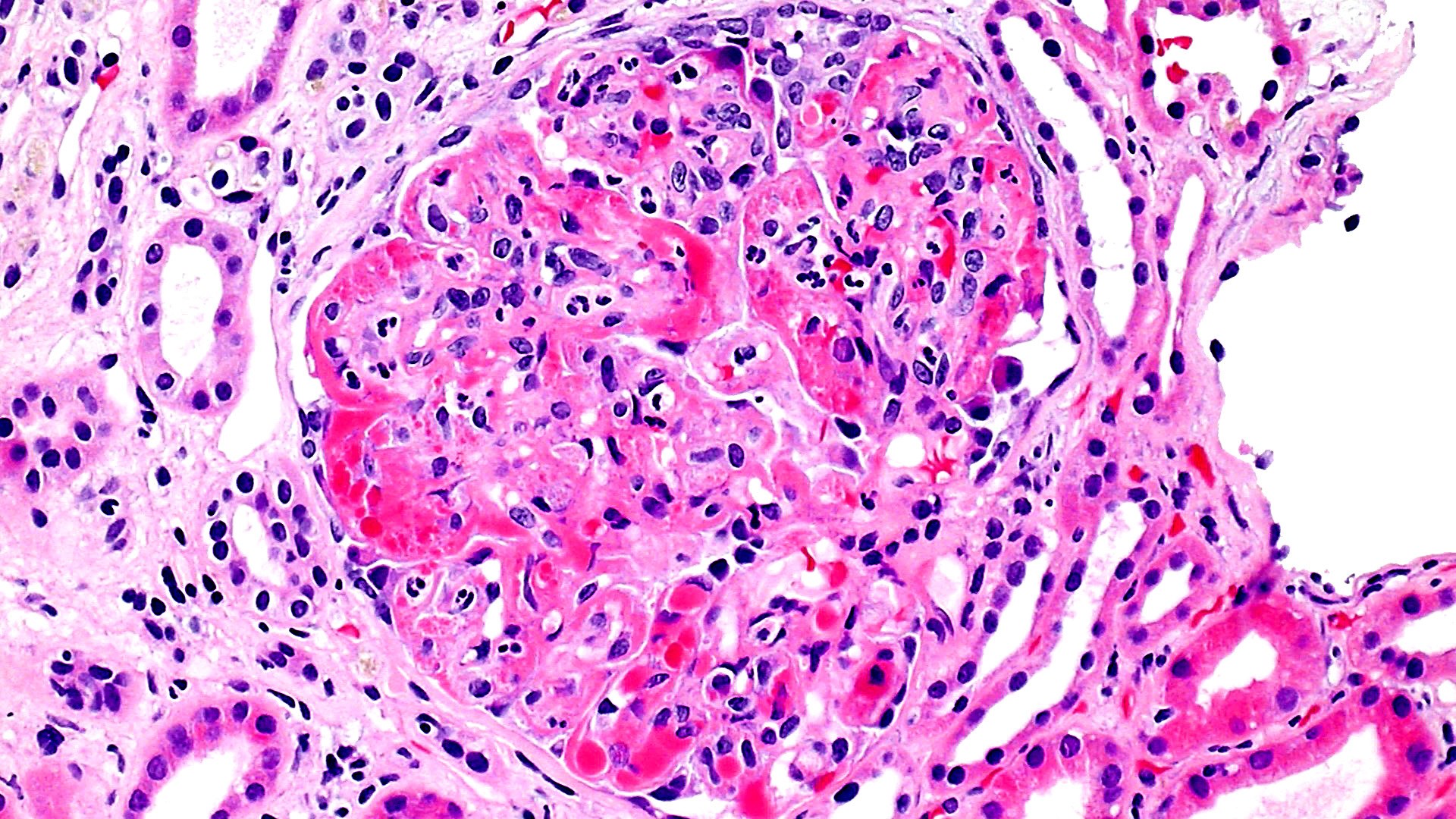 type I cryoglobulinemic glomerulonephritis