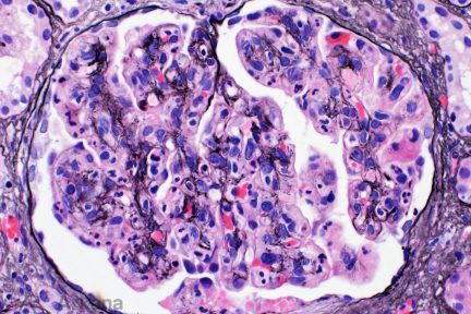 Membranoproliferative Glomerulonephritis