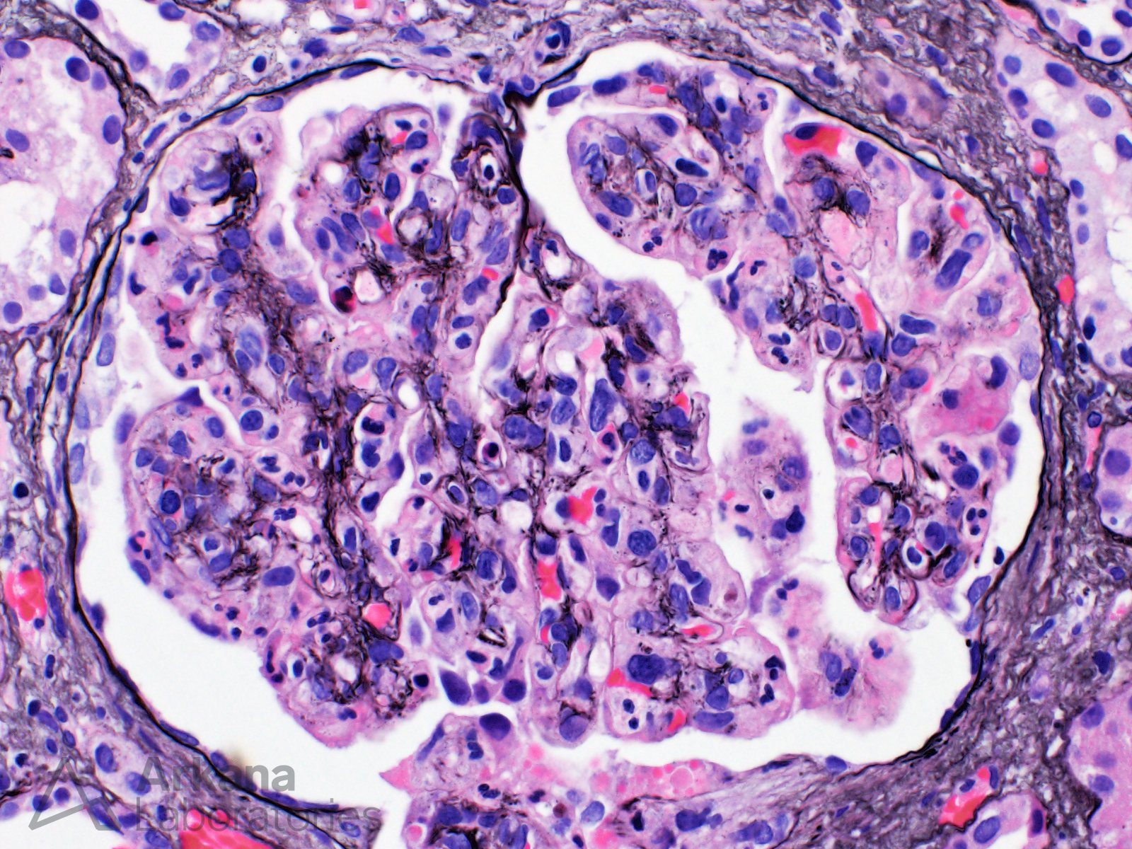 Membranoproliferative Glomerulonephritis