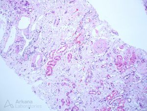 Amyloid, pushing glass, Dr. Kuperman, Congo Red Stain