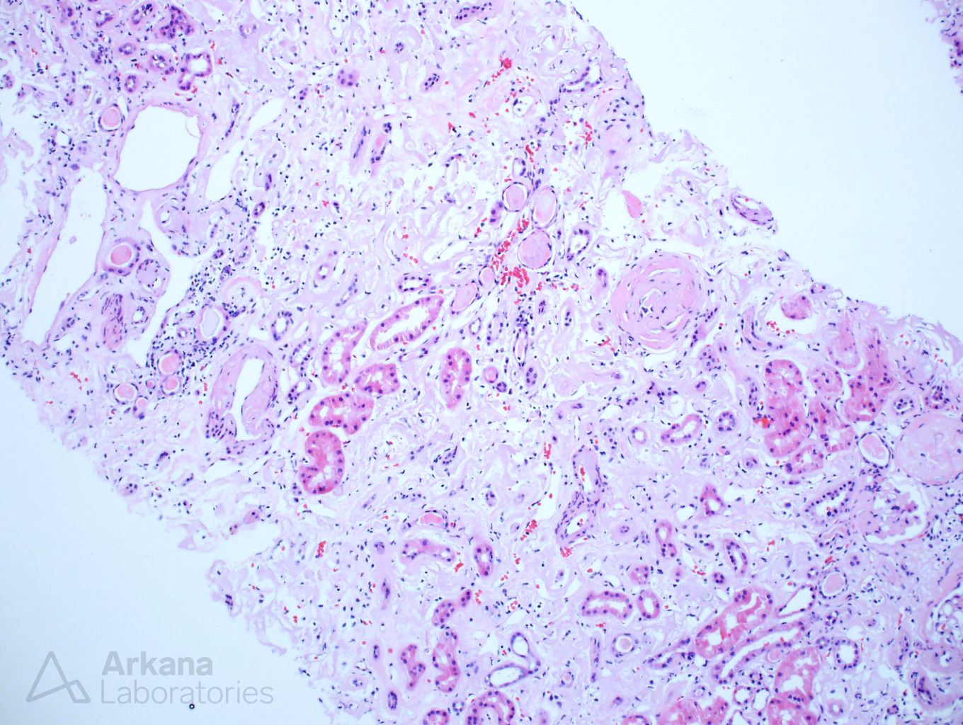 Amyloidosis, ALect2-Type