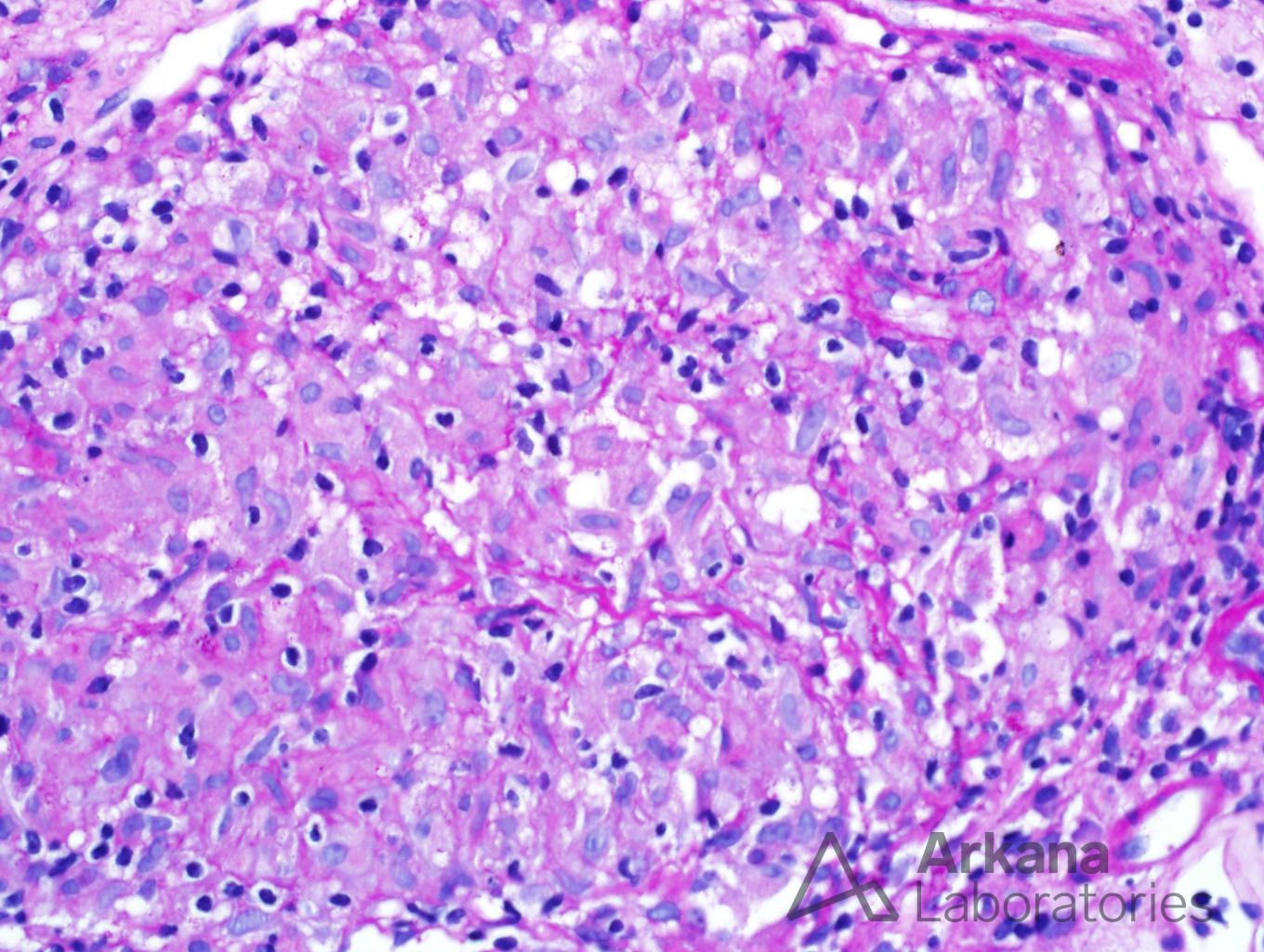 Granulomatous Interstitial Nephritis