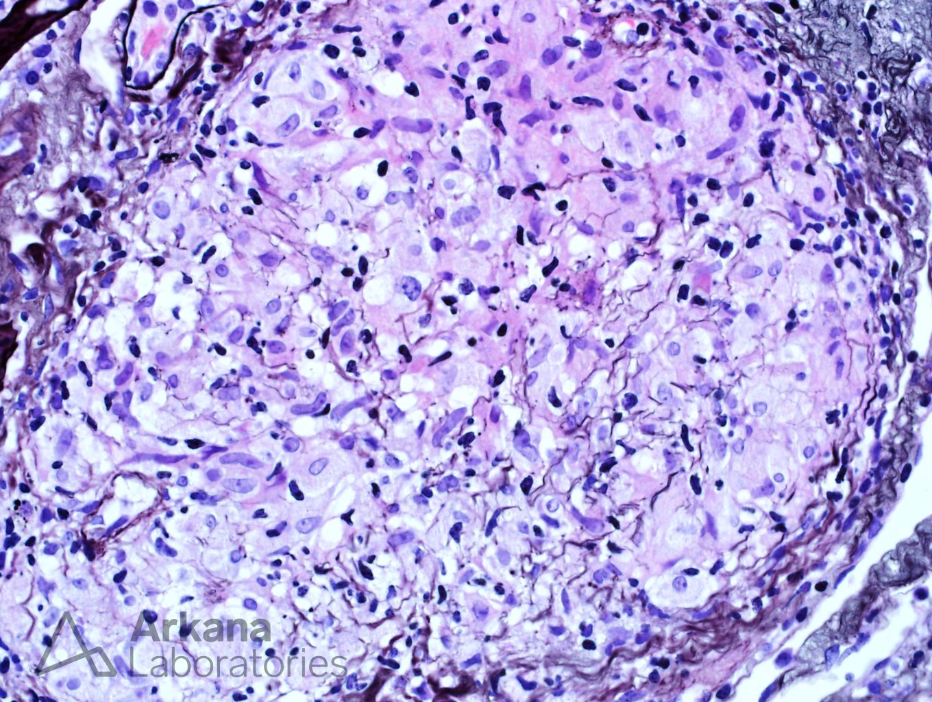 Granulomatous Interstitial Nephritis