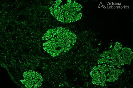 Lupus Nephritis ISN/RPS Class V