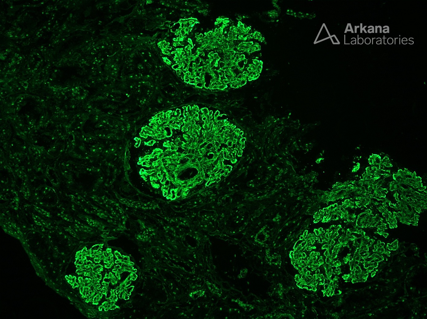 Lupus Nephritis ISN/RPS Class V