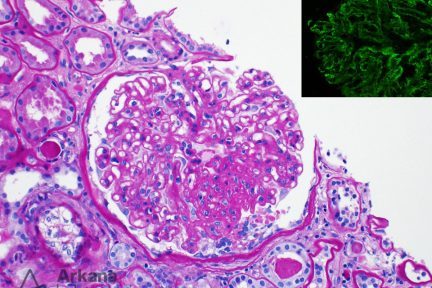 Membranous with FSGS