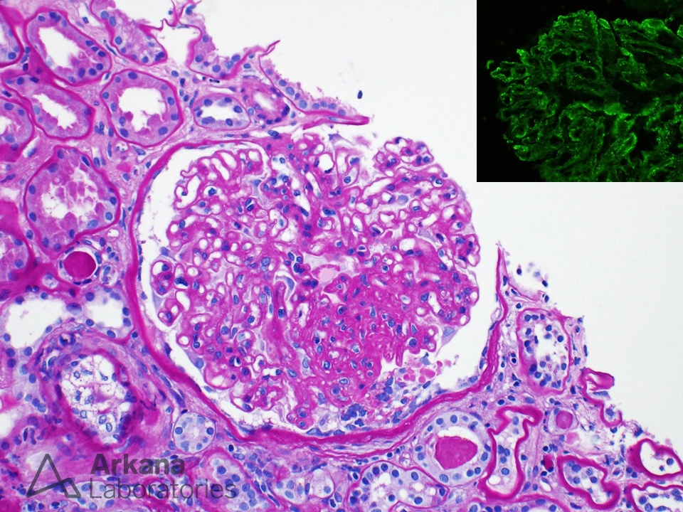 Membranous with FSGS