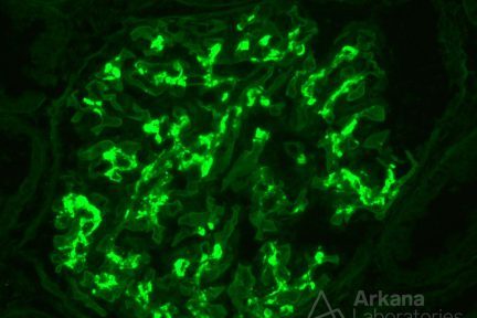 IgA nephropathy