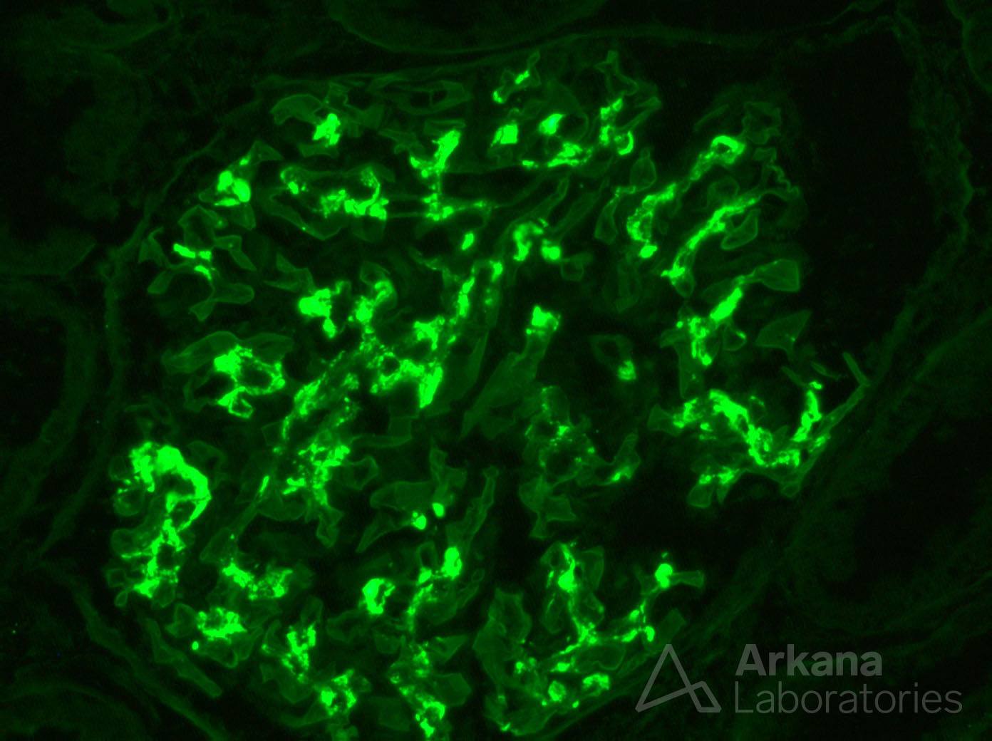 IgA nephropathy