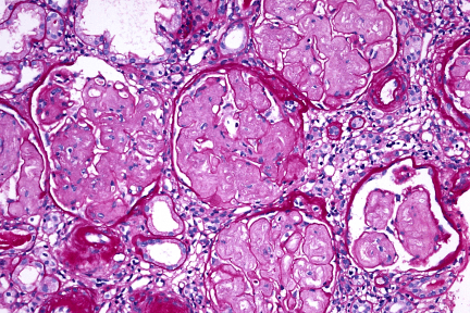 Collagenofibrotic Glomerulopathy