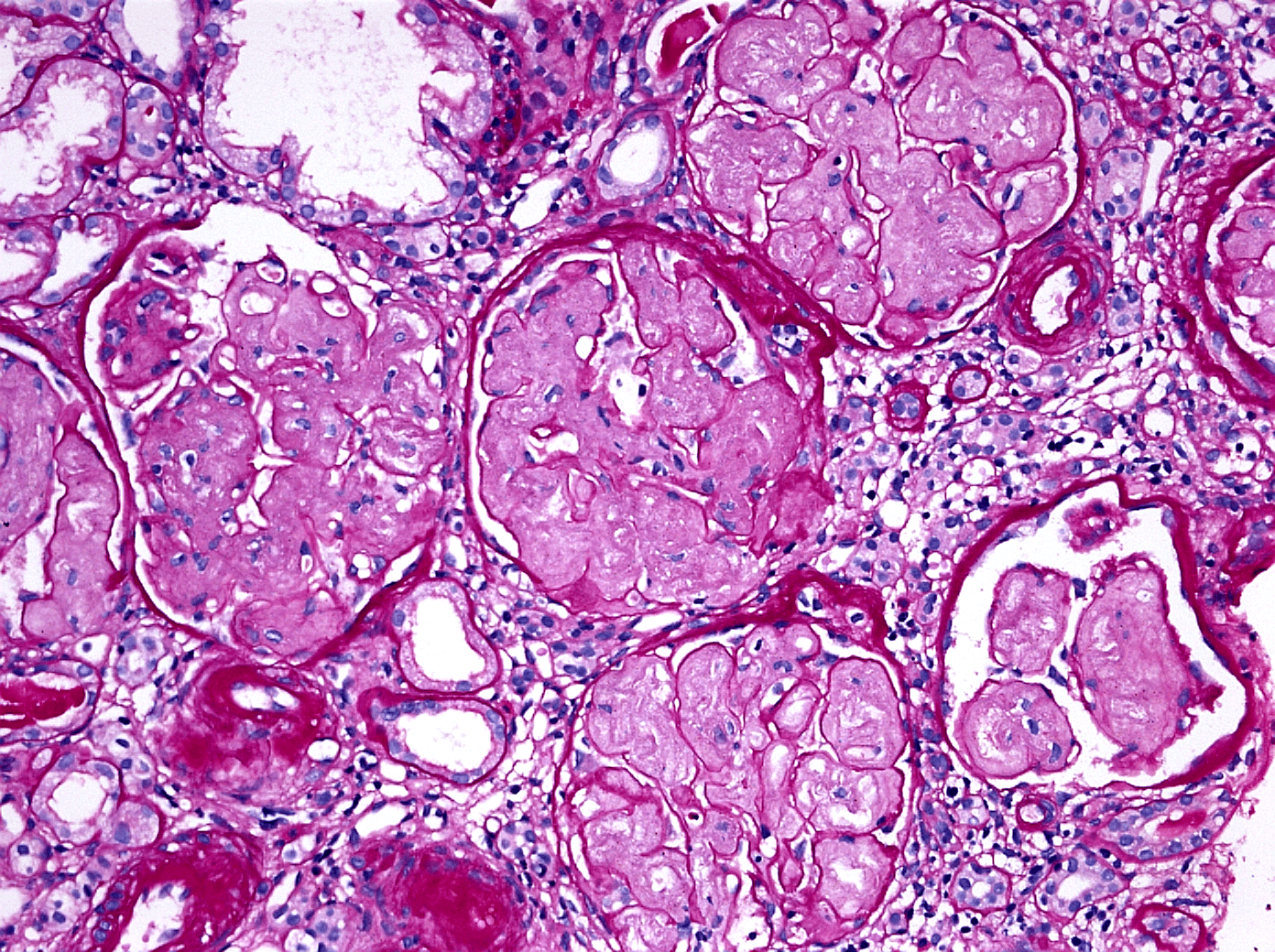 Collagenofibrotic Glomerulopathy