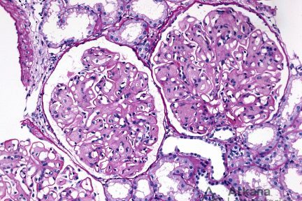 Collagenofibrotic Glomerulopathy