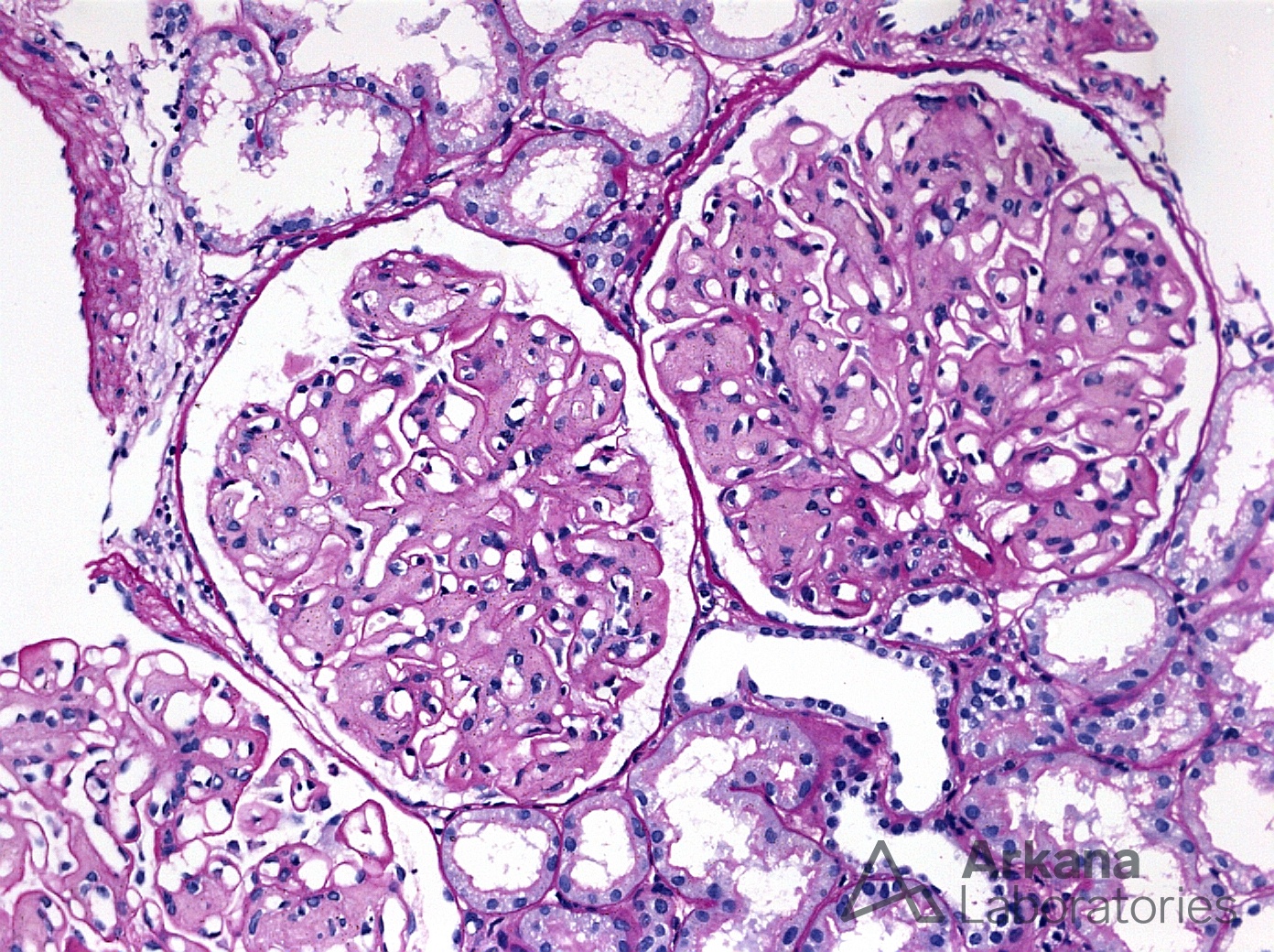 Collagenofibrotic Glomerulopathy